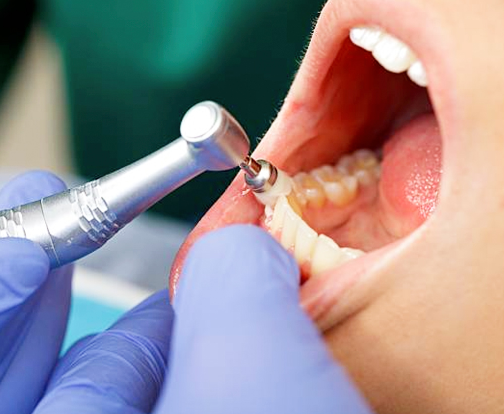 Preventative-Dentistry-Brentwood-Dental-Care-in-Bay-Shore-NY- Preventative Dentistry Brentwood Dental Care in Bay Shore NY