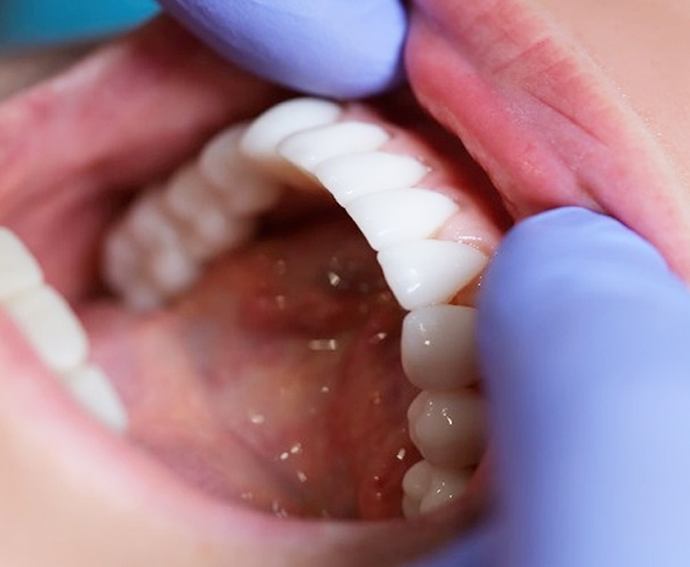 Preventative Dentistry in Bay Shore NY Brentwood Dental Care